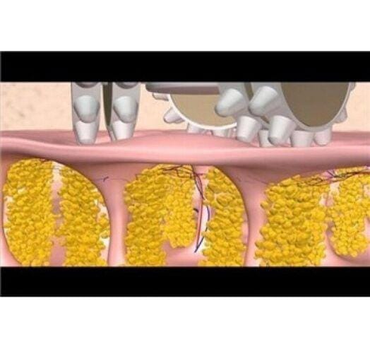 Масажер проти целюліту для всього тіла Benice Body Slimmer BS45 – фото 5